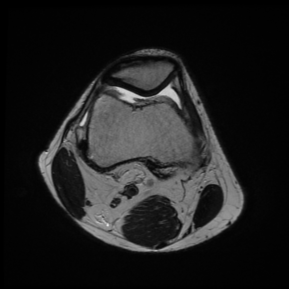 File:Anterior cruciate ligament graft tear and bucket-handle tear of medial meniscus (Radiopaedia 75867-87254 Axial T2 21).jpg