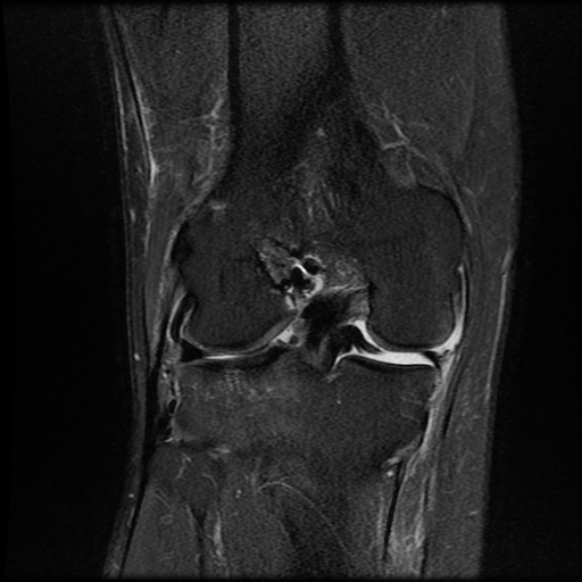 File:Anterior cruciate ligament graft tear and bucket-handle tear of medial meniscus (Radiopaedia 75867-87255 Coronal PD fat sat 17).jpg