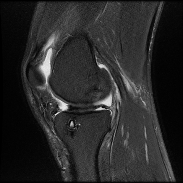 File:Anterior cruciate ligament graft tear and bucket-handle tear of medial meniscus (Radiopaedia 75867-87255 Sagittal PD fat sat 10).jpg