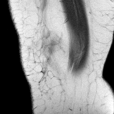 Anterior cruciate ligament mucoid degeneration (Radiopaedia 60853-68633 Sagittal T1 33).jpg