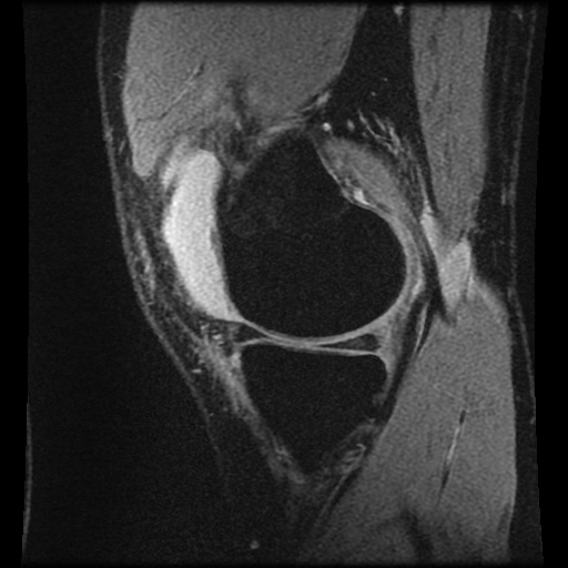 File:Anterior cruciate ligament tear (Radiopaedia 61500-69462 F 19).jpg