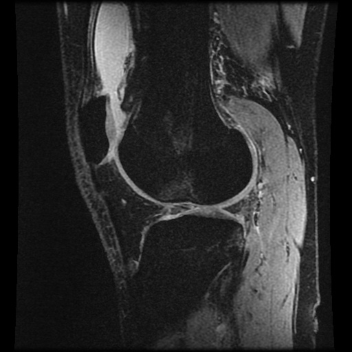 Anterior cruciate ligament tear (Radiopaedia 61500-69462 F 64).jpg