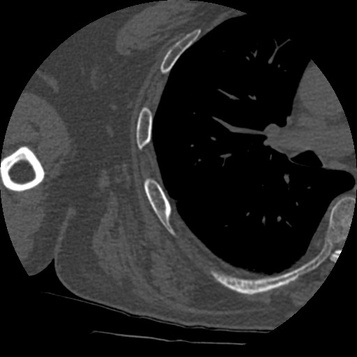 Anterior glenohumeral dislocation with Hill-Sachs lesion (Radiopaedia 62877-71249 Axial bone window 90).jpg