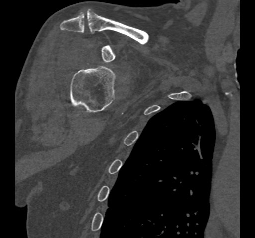 File:Anterior glenohumeral dislocation with Hill-Sachs lesion (Radiopaedia 62877-71249 Coronal bone window 23).jpg