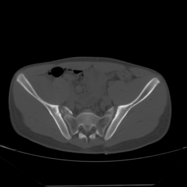 Anterior inferior iliac spine avulsion fracture (Radiopaedia 49469-54627 Axial bone window 16).jpg
