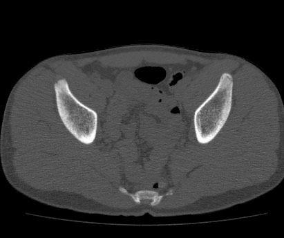 Anterior inferior iliac spine avulsion fracture (Radiopaedia 81312-94999 Axial bone window 44).jpg