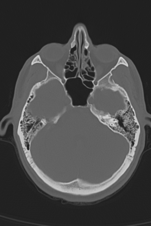 Anterior nasal spine fracture (Radiopaedia 46138-50494 Axial bone window 41).png