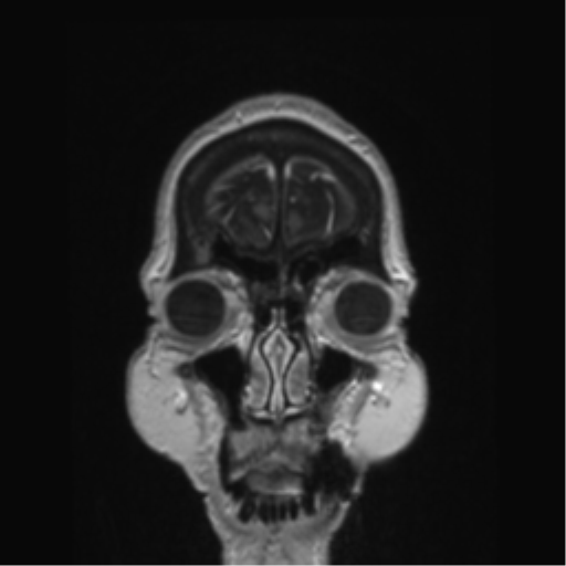 Anterior temporal pole cysts (Radiopaedia 46629-51102 Coronal T1 C+ 162).png