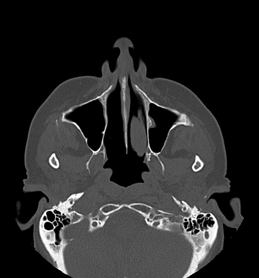 Anterior temporomandibular joint dislocation (Radiopaedia 59430-66784 Axial non-contrast 20).jpg