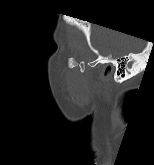 File:Anterior temporomandibular joint dislocation (Radiopaedia 59430-66784 B 4).jpg