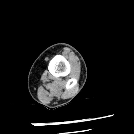 Anterior tibial artery false aneurysm (Radiopaedia 88984-105809 A 49).jpg
