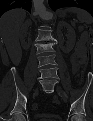File:Anterior vertebral scalloping (abdominal aortic aneurysm) (Radiopaedia 66744-76067 Coronal bone window 34).jpg
