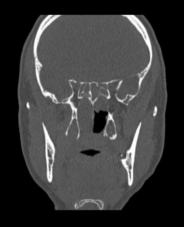 Antrochoanal polyp (Radiopaedia 79011-92169 Coronal bone window 28).jpg