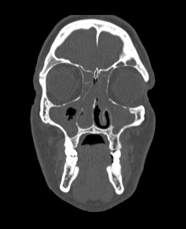 Antrochoanal polyp (Radiopaedia 79011-92169 Coronal bone window 61).jpg