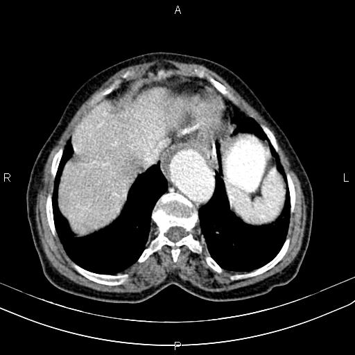 Aortic aneurysm and Lemmel syndrome (Radiopaedia 86499-102554 A 13).jpg