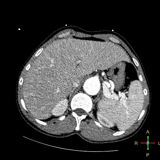 File:Aortic aneurysm and penetrating ulcer (Radiopaedia 23590-23704 A 29).jpg