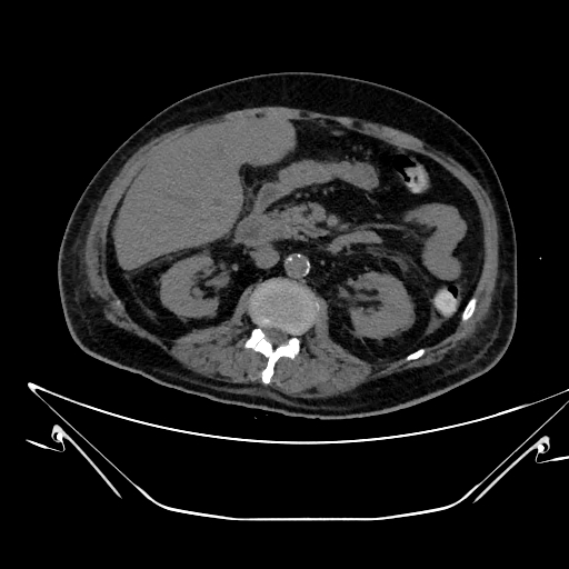 Aortic arch aneurysm (Radiopaedia 84109-99365 Axial non-contrast 334).jpg