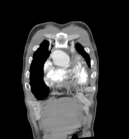 Aortic coarctation with aneurysm (Radiopaedia 74818-85828 C 16).jpg