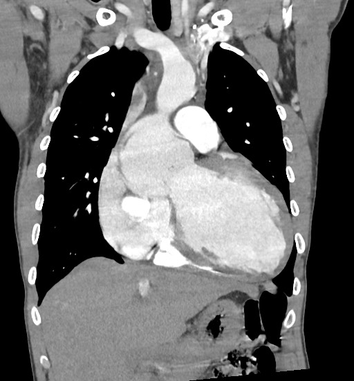 Aortic coarctation with aneurysm (Radiopaedia 74818-85828 C 45).jpg