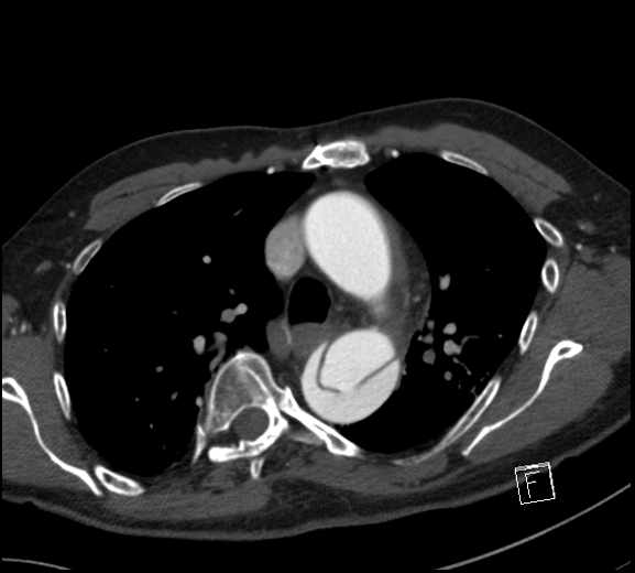 Aortic dissection (CTPA) (Radiopaedia 75506-86750 A 33).jpg