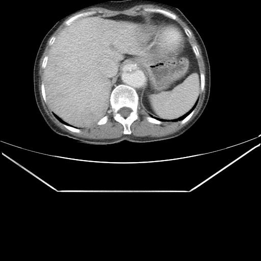 File:Aortic dissection (Radiopaedia 25350-25604 C 48).jpg