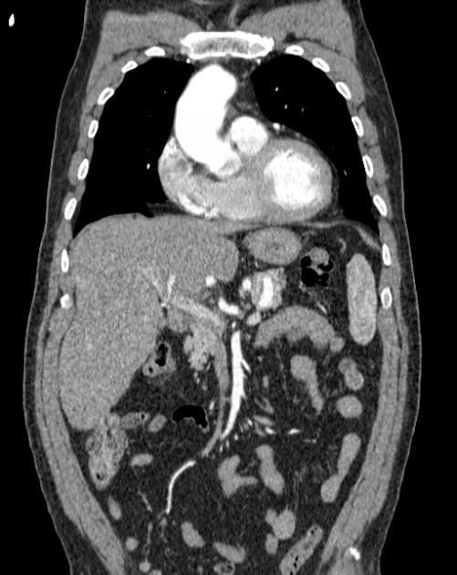 Aortic dissection (Radiopaedia 44411-48061 A 7).jpg