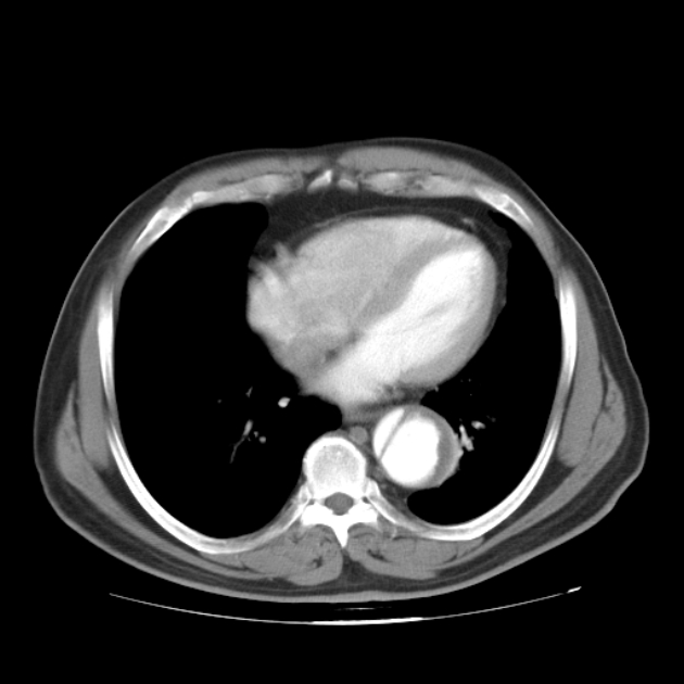 Aortic dissection (Radiopaedia 44411-48061 C 18).jpg