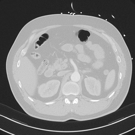 File:Aortic dissection (Radiopaedia 50763-56234 Axial lung window 70).png