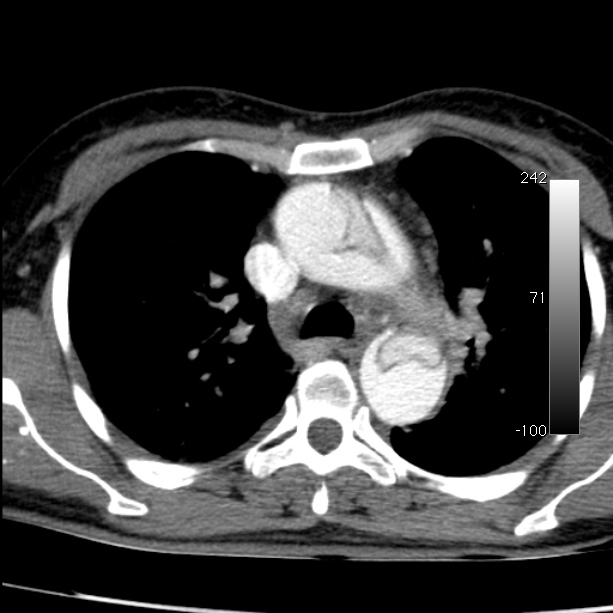 Aortic dissection - Stanford type A (Radiopaedia 29247-29659 A 27).jpg