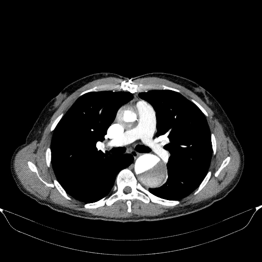 Aortic dissection - Stanford type A (Radiopaedia 83418-98500 A 29).jpg