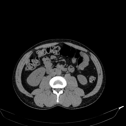 File:Aortic dissection - Stanford type A (Radiopaedia 83418-98500 Axial non-contrast 59).jpg