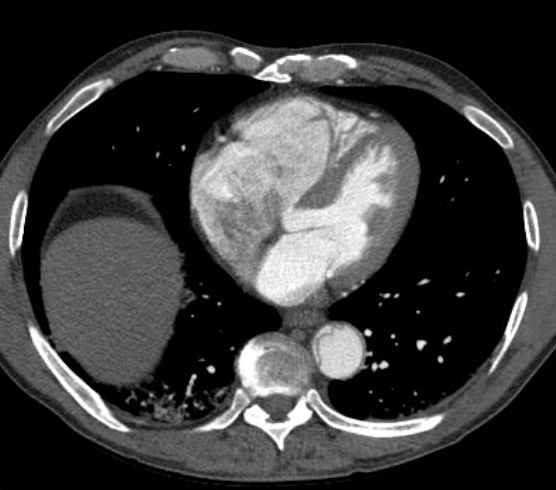 Aortic dissection - Stanford type B (Radiopaedia 73648-84437 A 76).jpg