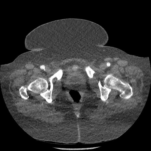 File:Aortic dissection - Stanford type B (Radiopaedia 88281-104910 A 160).jpg