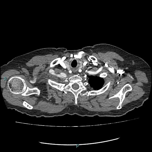 File:Aortic dissection extended to lusory artery (Radiopaedia 43686-47136 B 1).jpg