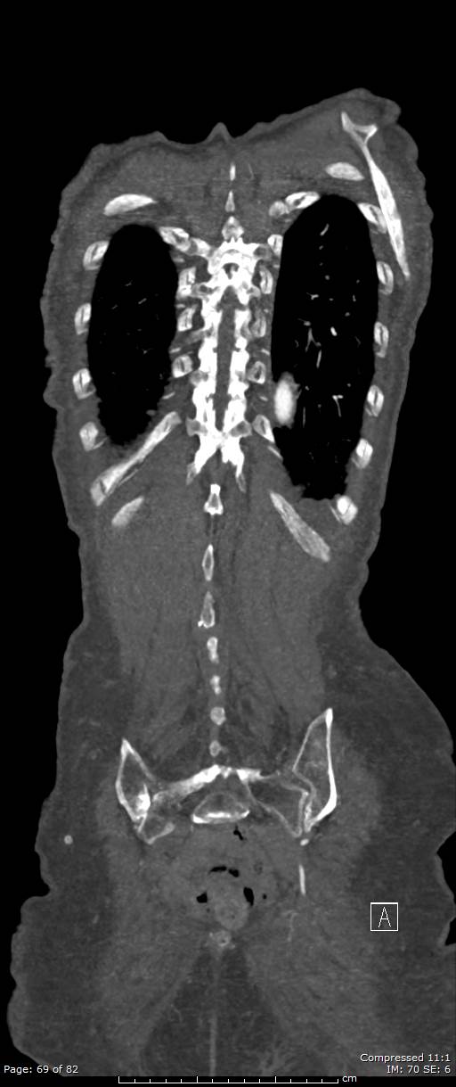Aortic dissection with extension into aortic arch branches (Radiopaedia 64402-73204 A 69).jpg