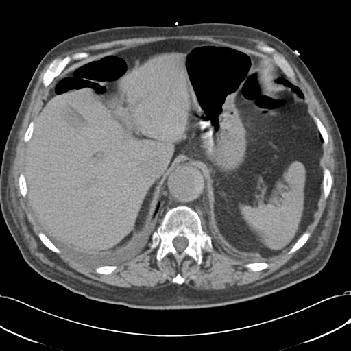 Aortic intramural hematoma (Radiopaedia 34260-35540 Axial non-contrast 56).png