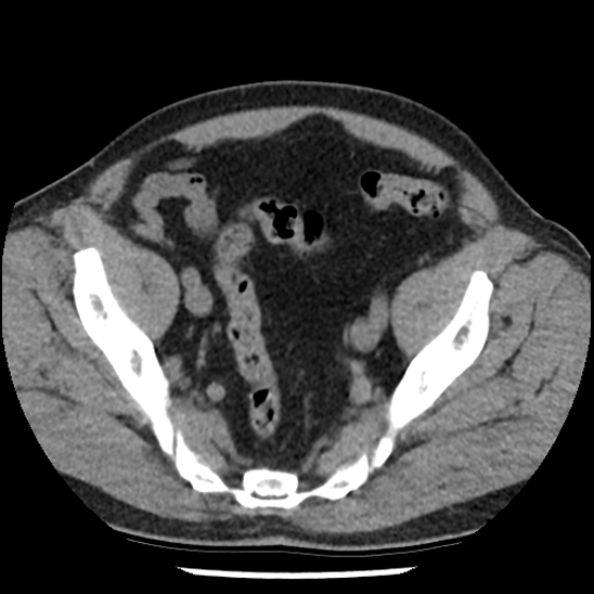 Aortic intramural hematoma (type B) (Radiopaedia 79323-92387 Axial non-contrast 100).jpg