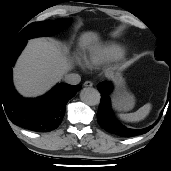 Aortic intramural hematoma (type B) (Radiopaedia 79323-92387 Axial non-contrast 44).jpg