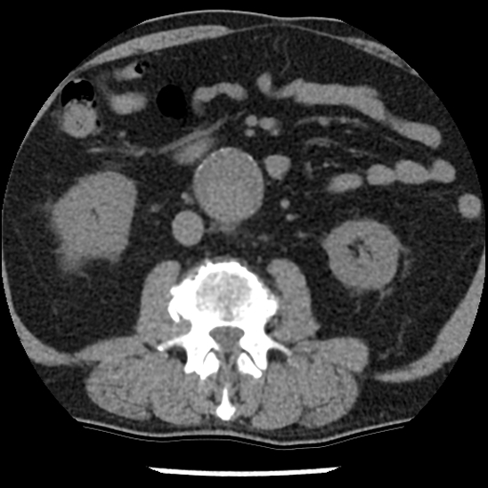 Aortic intramural hematoma (type B) (Radiopaedia 79323-92387 Axial non-contrast 73).jpg
