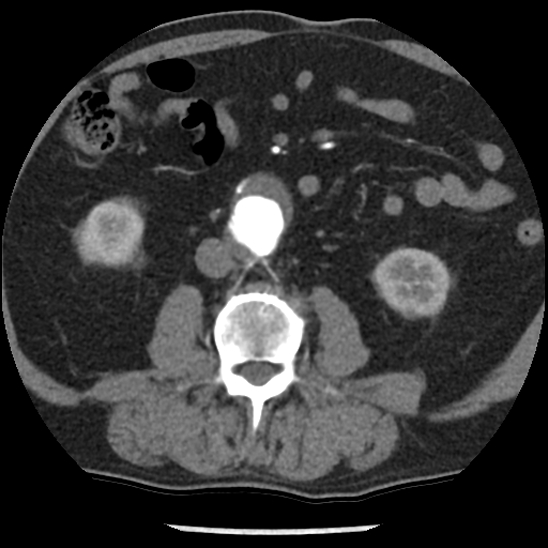 Aortic intramural hematoma (type B) (Radiopaedia 79323-92387 B 76).jpg
