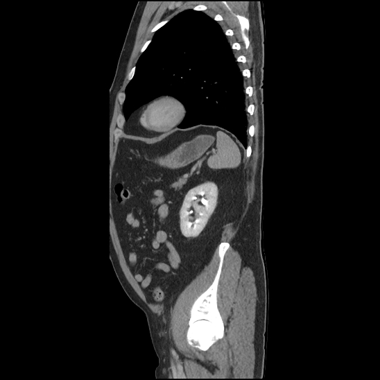 Aortic intramural hematoma (type B) (Radiopaedia 79323-92387 Sagittal C+ delayed 43).jpg