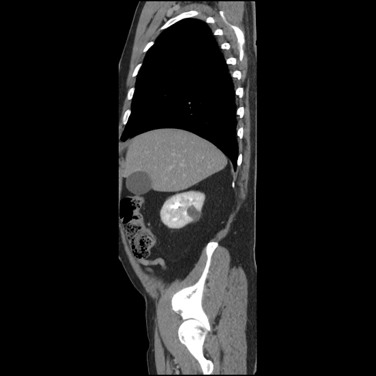 Aortic intramural hematoma (type B) (Radiopaedia 79323-92387 Sagittal C+ delayed 5).jpg