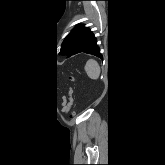 Aortic intramural hematoma (type B) (Radiopaedia 79323-92387 Sagittal C+ delayed 51).jpg