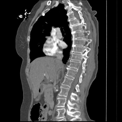 File:Aortic intramural hematoma from penetrating atherosclerotic ulcer (Radiopaedia 31137-31836 B 28).jpg