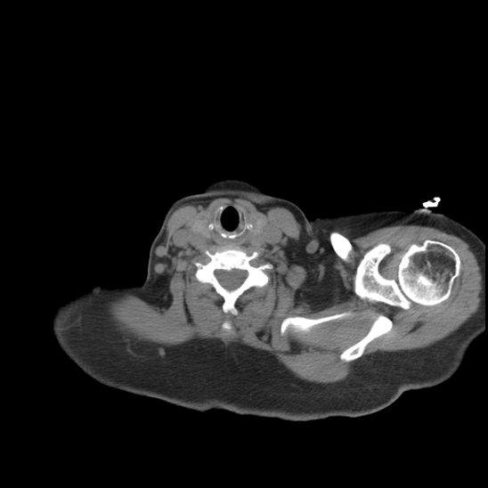 Aortic intramural hematoma with dissection and intramural blood pool (Radiopaedia 77373-89491 Axial non-contrast 3).jpg