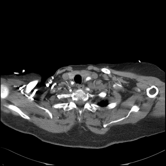 Aortic intramural hematoma with dissection and intramural blood pool (Radiopaedia 77373-89491 B 25).jpg