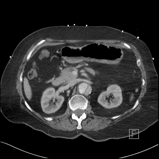 Aortic intramural hematoma with dissection and intramural blood pool (Radiopaedia 77373-89491 E 21).jpg