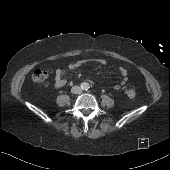 Aortic intramural hematoma with dissection and intramural blood pool (Radiopaedia 77373-89491 E 57).jpg