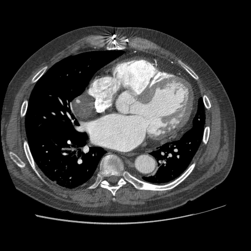 File:Aorto-coronary bypass graft aneurysms (Radiopaedia 40562-43157 A 74).png