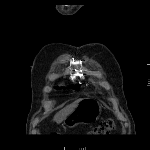 File:Aorto-coronary bypass graft aneurysms (Radiopaedia 40562-43157 B 2).png